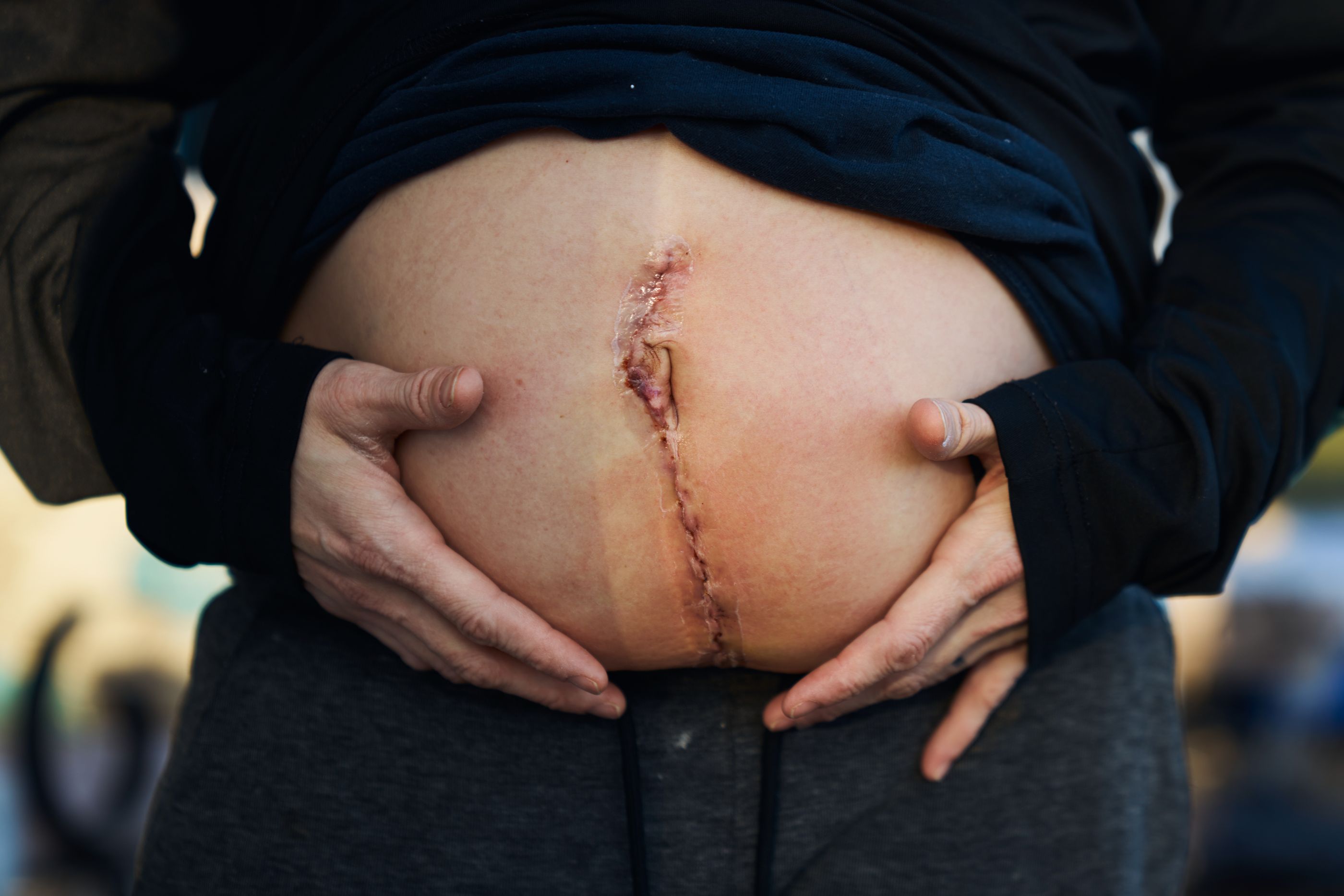 Doctors Warned Her Pregnancy Could Kill Her. Then Tennessee Outlawed Abortion. (propublica.org)