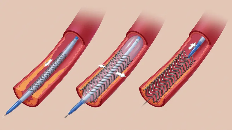 An illustrated cross-section of an artery in which a mesh structure is inserted, then expanded by a balloon. The mesh is left in place, keeping the artery open.